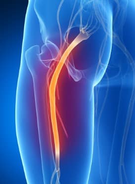 Lombosciatalgie traitement naturel