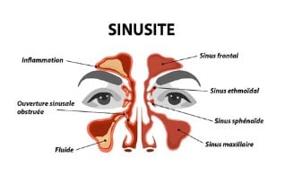 Sinusite massage pour soulager les symptomes