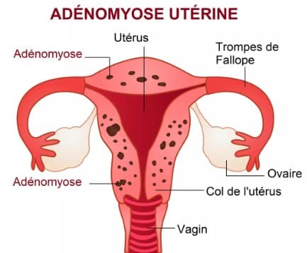 Adénomyose traitement naturel