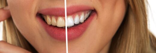 Astuces pour avoir les dents blanches