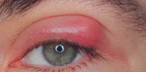 Paupières gonflées remède grand-mère