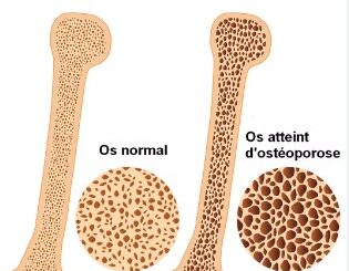 Traitement naturel contre l'ostéoporose