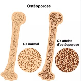 Traitement naturel contre l'ostéoporose