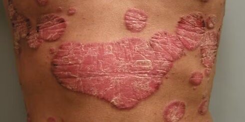 Traiter le psoriasis naturellement