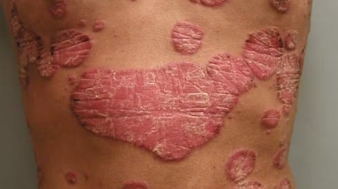 Traiter le psoriasis naturellement