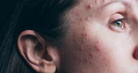 Bouton de stress remède naturel
