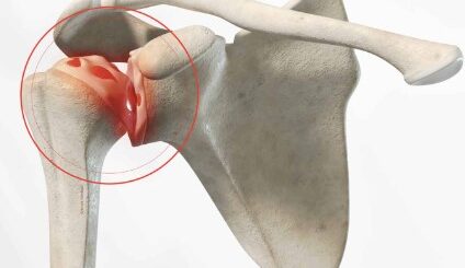 Arthrose traitement naturel