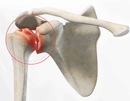 Arthrose traitement naturel