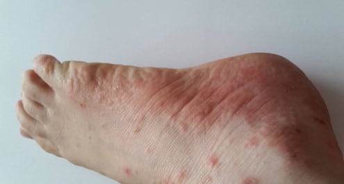 Dyshidrose traitement naturel