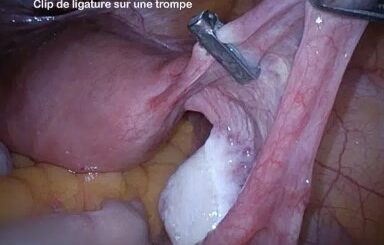 Effets secondaires ligature des trompes
