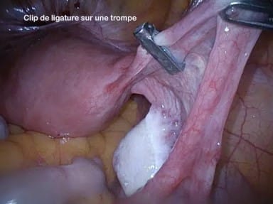 Effets secondaires ligature des trompes
