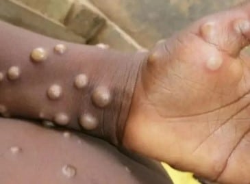 Variole du singe traitement