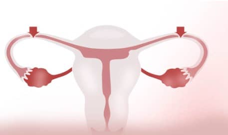 Peut on tomber enceinte avec une ligature des trompes