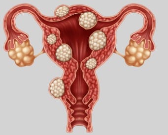 Est-ce que l'endométriose peut partir