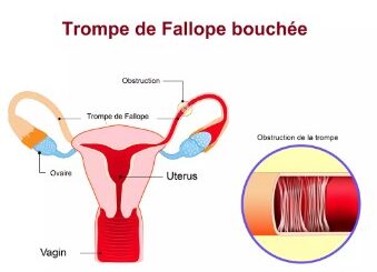 Trompes de fallope bouchées solutions