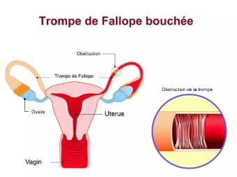 Trompes de fallope bouchées solutions