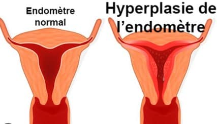 Quelle est l'épaisseur normale de l'endomètre