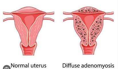 Adénomyose et endométriose en même temps