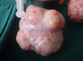 fibrome empêche de tomber enceinte