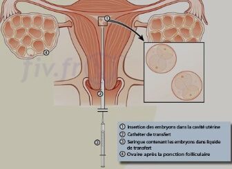 symptômes post transfert embryonnaire positif