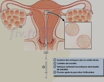 symptômes post transfert embryonnaire positif