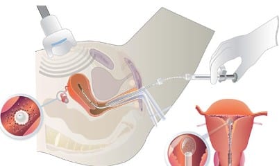 Insémination avec donneur