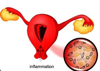 Endométrite chronique traitement naturel