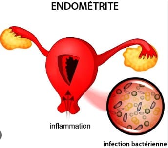 Endométrite chronique traitement naturel