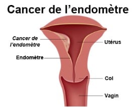 Hyperplasie de l endomètre et fatigue