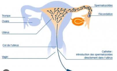 insémination artificiel chez la femme