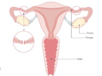 Ligature trompes avantages inconvénients