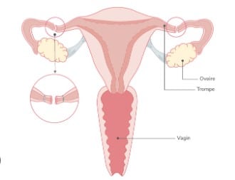 Ligature trompes avantages inconvénients