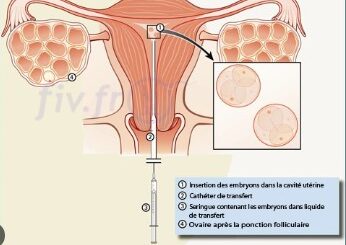 Transfert embryon j3 taux de reussite