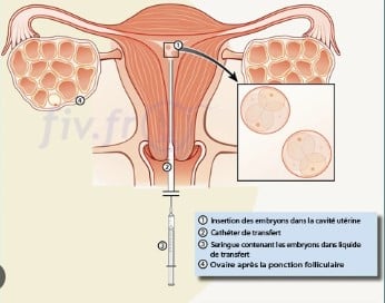 Transfert embryon j3 taux de reussite