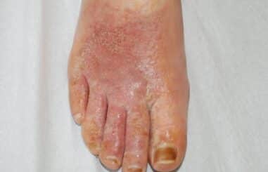 Démangeaisons aux pieds traitement naturel