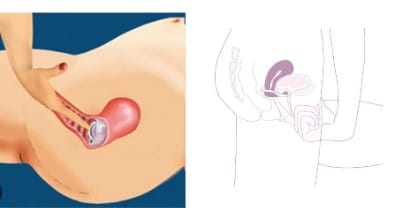 Cape cervicale inconvénients