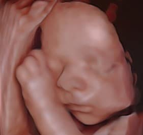 échographie 3D bébé