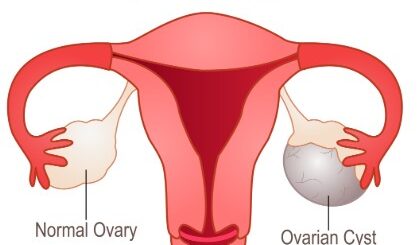 Recettes naturelles contre kystes