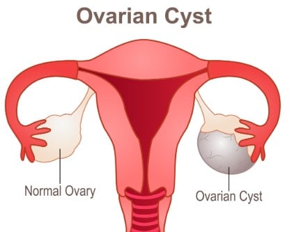 Recettes naturelles contre kystes