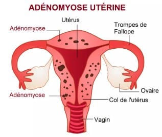 comment apaiser l’utérus avec des remèdes bio ?