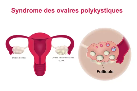 Symptômes Ovaires Polykystiques Traitement