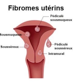 symptomes fibromes